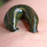 Leech therapy