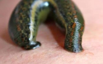 Leech therapy